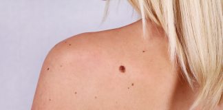 Cel mai des întâlnit tip de cancer. Cum se verifică riscul unei alunițe