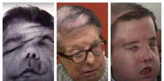 Omul cu 3 fețe. O premieră medicală de excepție și o poveste ca-n filme omul cu 3 fețe