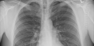 Test. Tu știi câți ani au plămânii tăi? bpoc spirometrii gratuite plămân plămâni