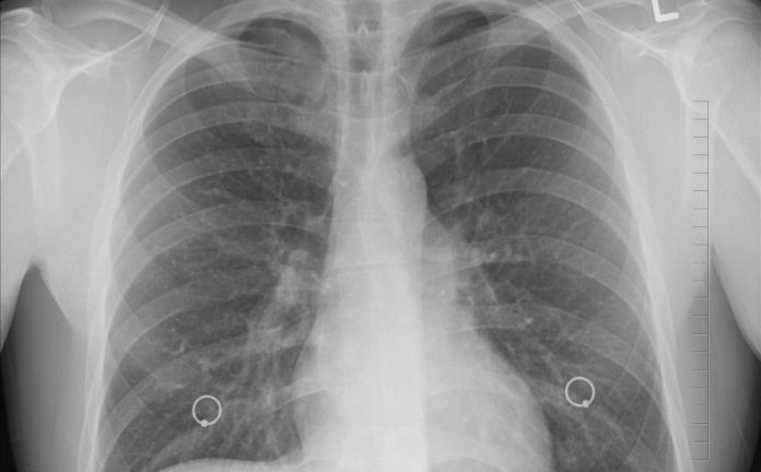 bpoc spirometrii gratuite plămân plămâni