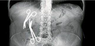 Un chirurg șef de secție a uitat două foarfece de 16 cm în burta unei paciente foarfece uitate burtă gheorghe ștefan medic