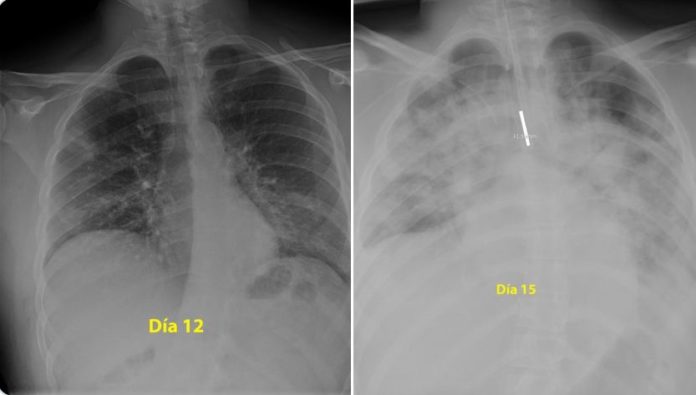 coronavirus plămâni
