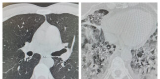 Vaccinați versus nevaccinați. Tineri, bătrâni, cu sau fără alte boli: cum arată plămânii pacienților plămân covid