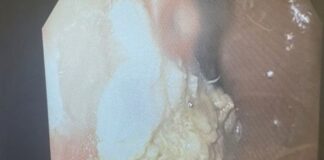 Ce au descoperit medicii când i-au făcut o radiografie unui copil de 5 ani. Ce era bulgărele uriaș din stomacul său gumă de mestecat stomac copil 5 ani