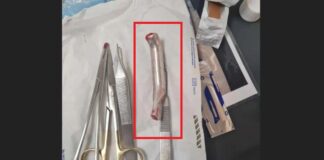 Ce amendă a primit spitalul unde un medic a uitat o frână de bicicletă în rana unui pacient mâner de bicicletă