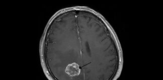 O femeie cu dureri de cap ce credea că suferă de sinuzită a aflat că are o tumoare la creier