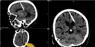 O femeie a trăit 80 de ani cu un ac de 3 cm în creier. Părinții ar fi încercat să o omoare la naștere ac creier