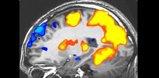Ce au descoperit medicii în creierul unui bărbat care suferea de migrene frecvente creier